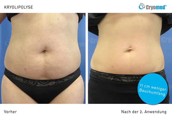 Bauch,Kryolipolyse, Müllheim,Neuenburg