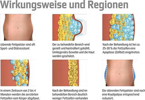 Wirkungsweise und Regionen, Kryolipolsye, Müllheim, Neuenburg